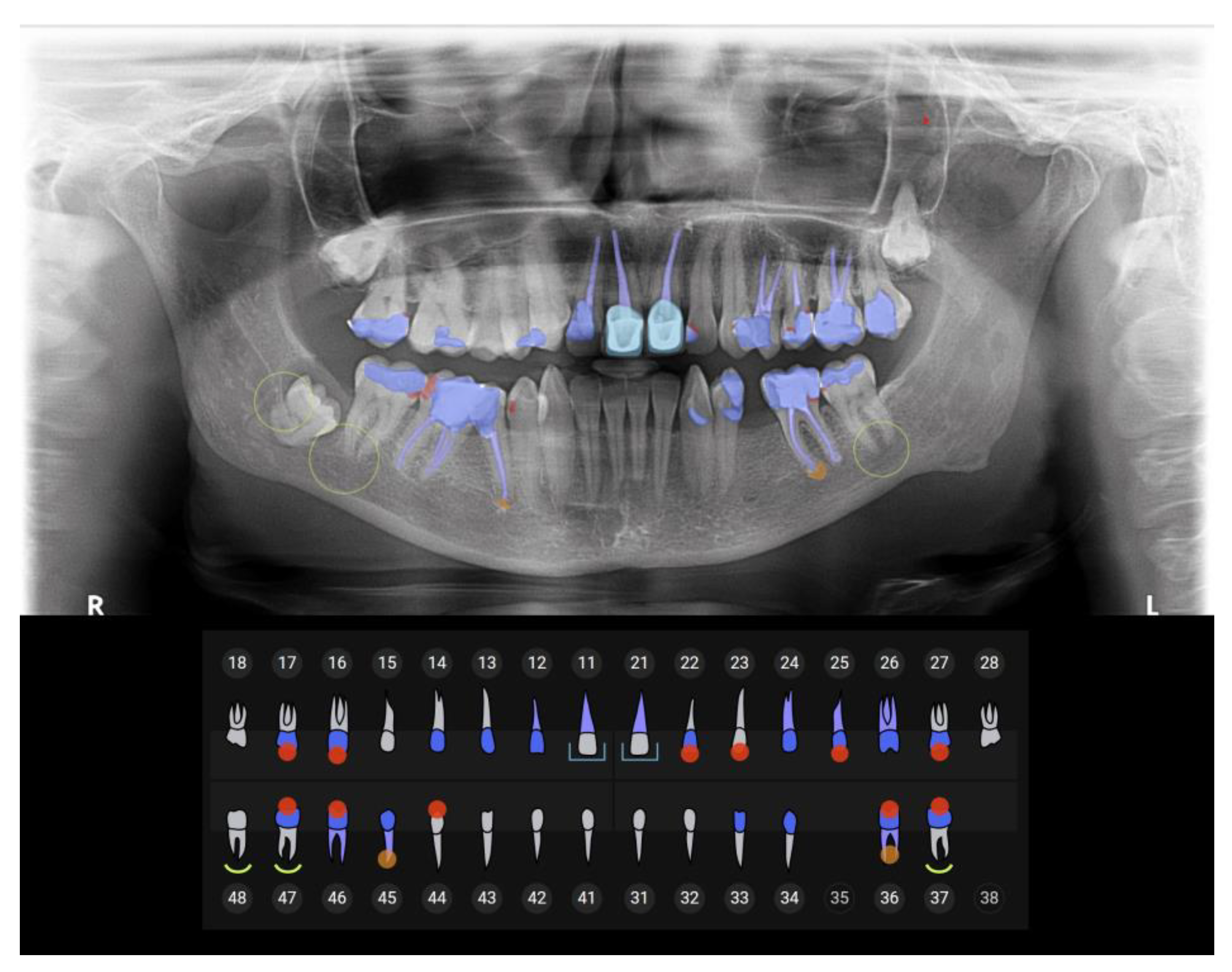 Bone Loss Detection on X-Ray Teeth